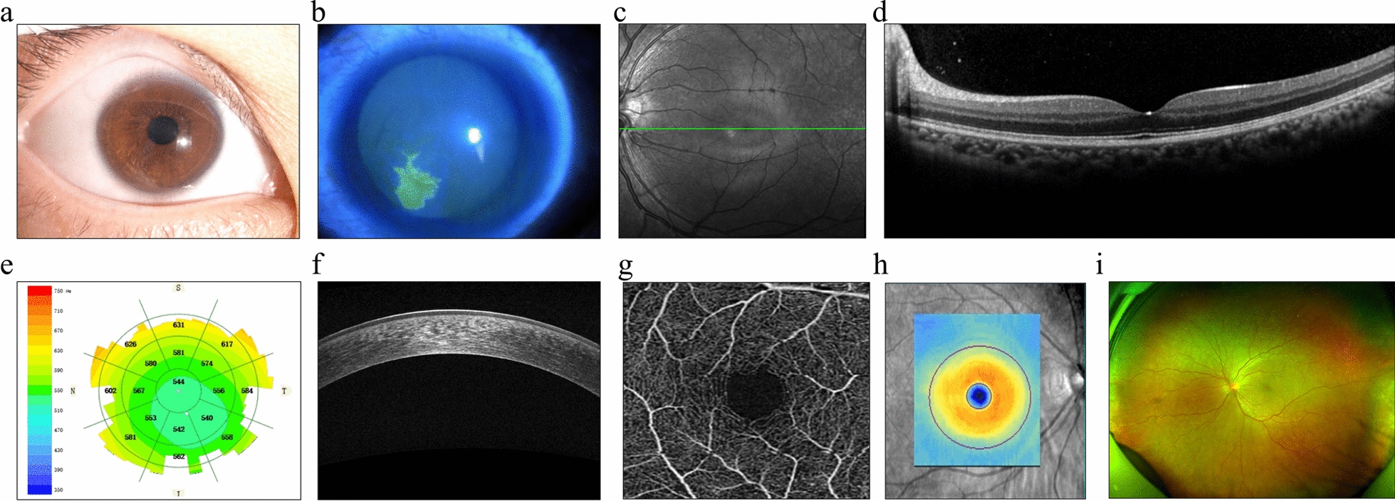 Advances and prospects of multi-modal ophthalmic artificial intelligence based on deep learning: a review.