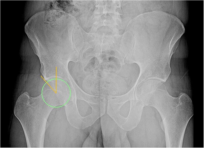 Review of femoroacetabular impingement syndrome.