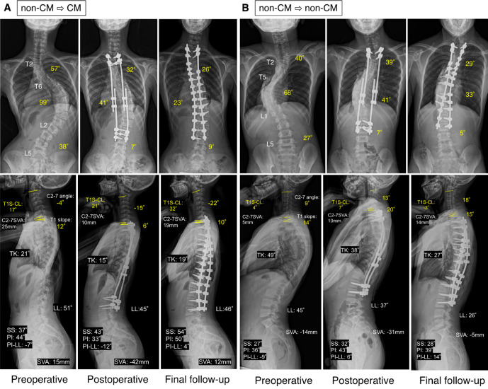 Impact of Growing Rod Surgery for Early-Onset Scoliosis on Cervical Sagittal Alignment.