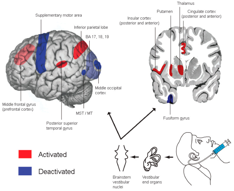 Bedside Neuromodulation of Persistent Pain and Allodynia with Caloric Vestibular Stimulation.