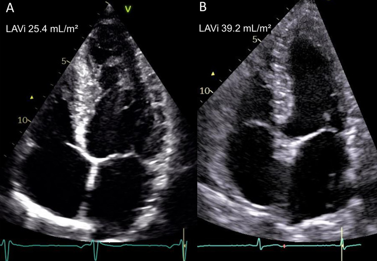 Left atrial volume assessed by echocardiography identifies patients with high risk of adverse outcome after acute myocardial infarction.