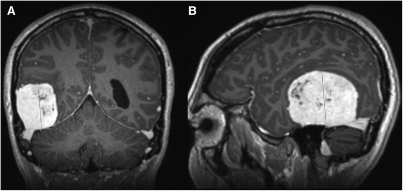 Giant Intracranial Meningiomas Requiring Surgery in 2 Transgender Women Treated With Cyproterone Acetate.