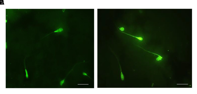 The Relationship between The Expression of Sperm <i>MicroRNA-149b</i> and <i>34c</i> and Sperm Quality in Men with Oligoasthenoteratozoospermia in Endometriosis.