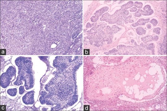 Spindle cell variant of ameloblastic carcinoma: A diagnostic challenge.