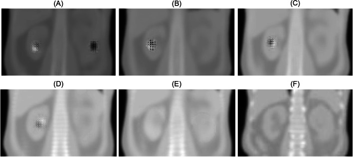 Deep-learning-based attenuation map generation in kidney single photon emission computed tomography.