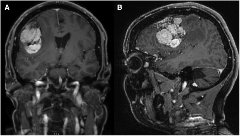 Giant Intracranial Meningiomas Requiring Surgery in 2 Transgender Women Treated With Cyproterone Acetate.