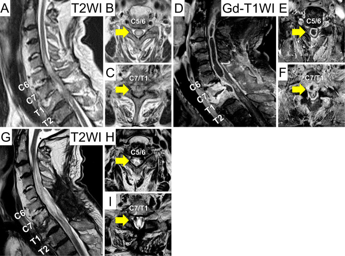 Intramedullary Spinal Cord Abscess due to Traumatic Esophageal Perforation Associated with Cervicothoracic Anterior Osteophytes: A Case Report.
