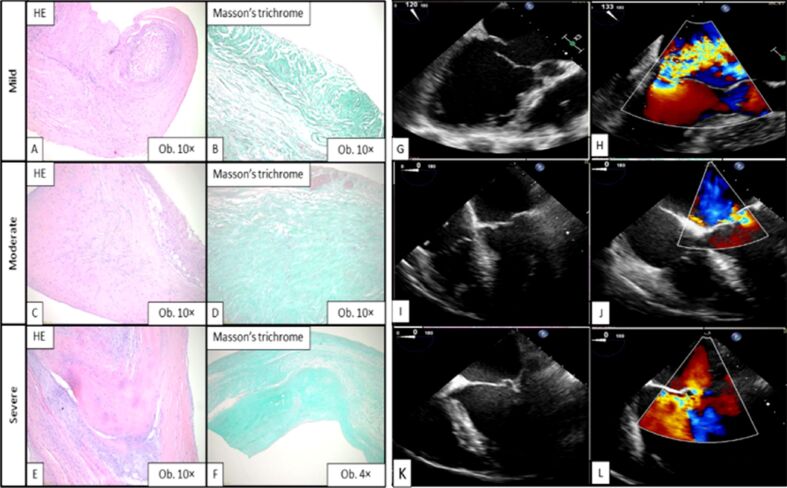 Significance of inflammation-related markers and histopathological features in mitral valve regurgitation.