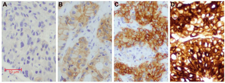 Anti-MET Antibody Therapies in Non-Small-Cell Lung Cancer: Current Progress and Future Directions.