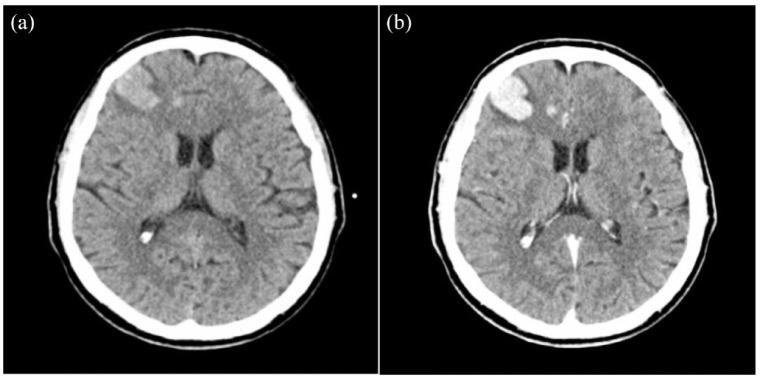 Should we be afraid of radiotherapy for hemorrhagic brain metastases? A narrative review.