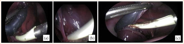 Comparison of postoperative outcomes between different dissection techniques during laparoscopic cholecystectomy in rabbits: randomized study.