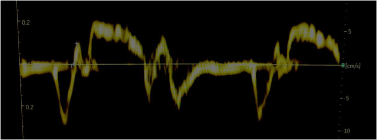 Improvements of right ventricular function after intervention with CPAP in patients with obstructive sleep apnoea.
