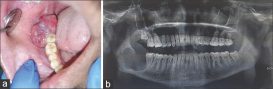 Spindle cell variant of ameloblastic carcinoma: A diagnostic challenge.