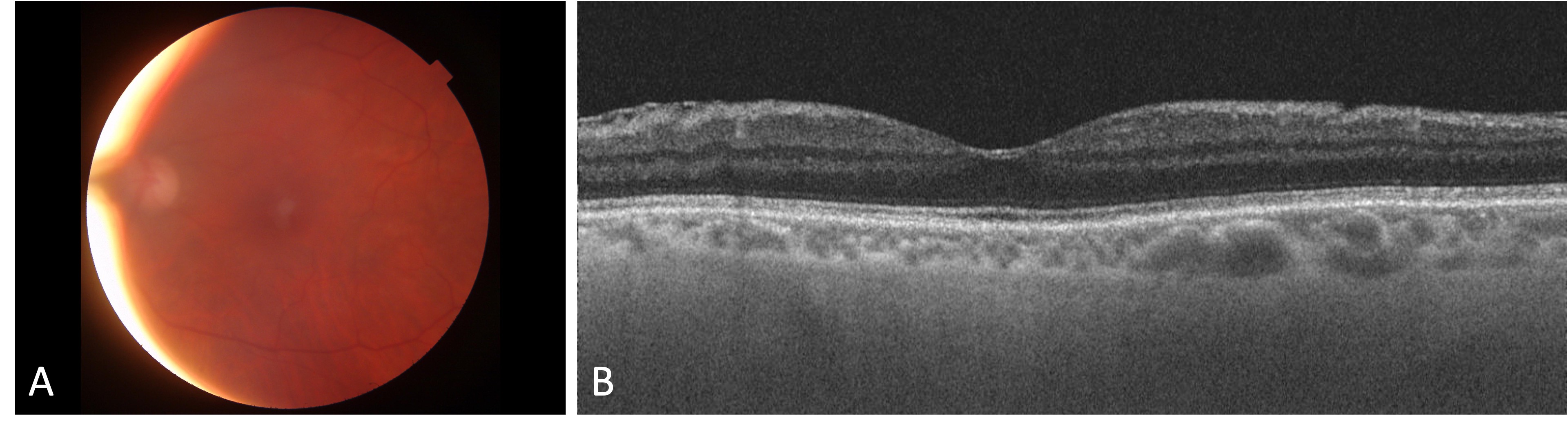 Visual Recovery and Endothelial Repopulation after DMEK Graft Removal and Vitrectomy for Late Endophthalmitis: A Case Report.