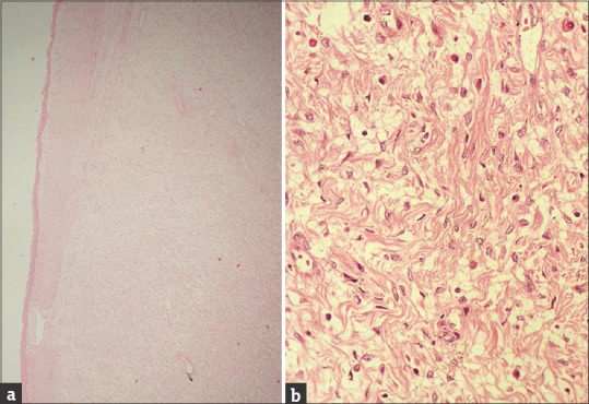 Cervical Superficial Myofibroblastoma Presenting as a Polyp: A Rare Benign Entity.