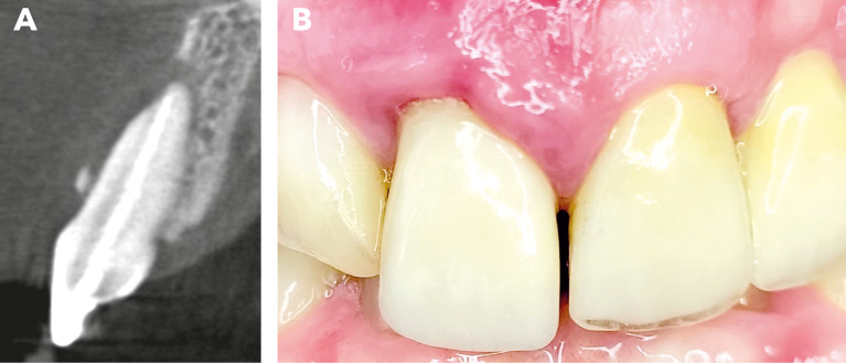 Enhanced alveolar ridge preservation with hyaluronic acid-enriched allografts: a comparative study of granular allografts with and without hyaluronic acid addition.