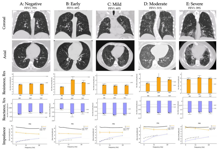 Application of Forced Oscillation Technique in Assessing Pulmonary Fibrosis in Hermansky-Pudlak Syndrome.