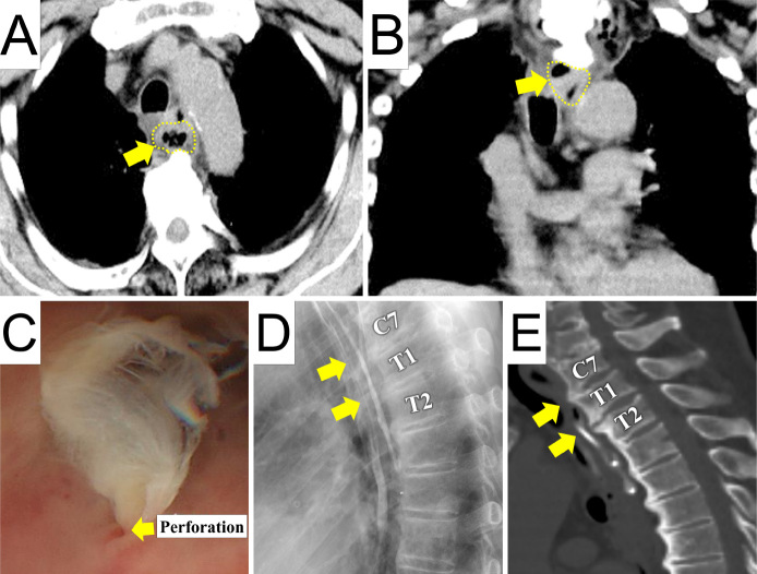 Intramedullary Spinal Cord Abscess due to Traumatic Esophageal Perforation Associated with Cervicothoracic Anterior Osteophytes: A Case Report.