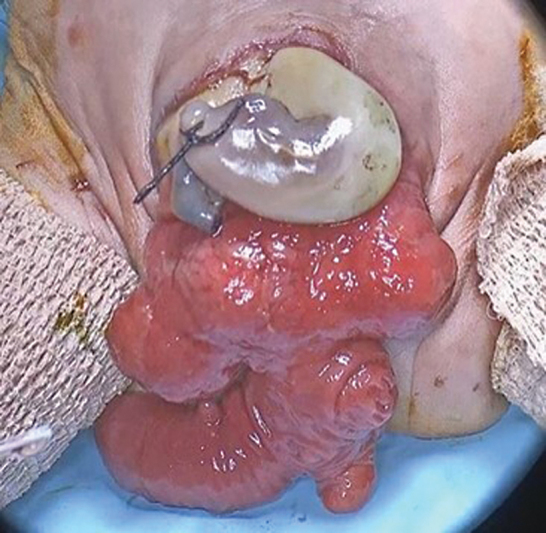 A Modification of the Newborn Operation for Cloacal Exstrophy: Leaving the Cecal Plate Untouched.