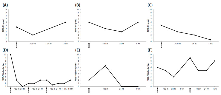 Bedside Neuromodulation of Persistent Pain and Allodynia with Caloric Vestibular Stimulation.