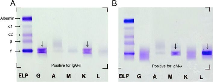 Warning values of serum total kappa/lambda ratio for M-proteinemia.