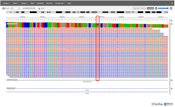 Renal hypouricemia type 2 with SLC2A9 compound heterozygous variants: a case report of recurrent acute kidney injury triggered by low-intensity exercise.