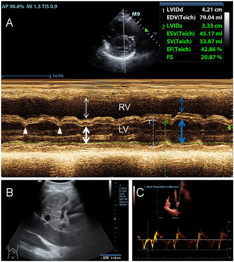 Delayed Diagnosis of Constrictive Pericarditis Resulting in Recurrent Heart Failure: A Case Report.