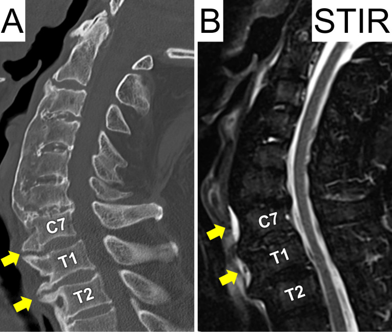 Intramedullary Spinal Cord Abscess due to Traumatic Esophageal Perforation Associated with Cervicothoracic Anterior Osteophytes: A Case Report.