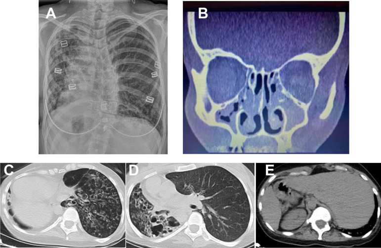 A novel alpha-1 antitrypsin gene variant in a patient with Kartagener's syndrome: a case report.