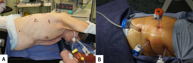 Comparative Analysis of Surgical Outcomes in Hybrid and Open Esophagectomy for Esophageal Cancer: A Regional Russian Cancer Centre Experience.