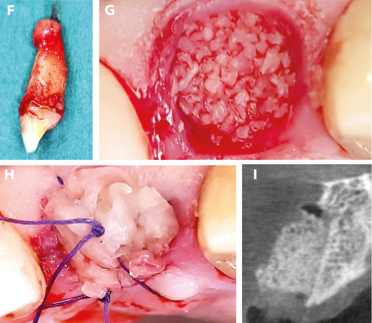 Enhanced alveolar ridge preservation with hyaluronic acid-enriched allografts: a comparative study of granular allografts with and without hyaluronic acid addition.