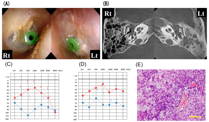 Seven cases illustrating difficulties in the treatment of MPO-ANCA-positive refractory otitis media.