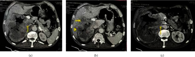 Renal Cell Carcinoma Masquerading as Acute Upper Gastrointestinal Bleeding.