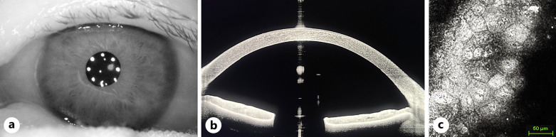 Visual Recovery and Endothelial Repopulation after DMEK Graft Removal and Vitrectomy for Late Endophthalmitis: A Case Report.