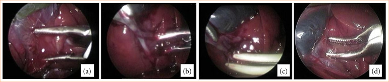 Comparison of postoperative outcomes between different dissection techniques during laparoscopic cholecystectomy in rabbits: randomized study.