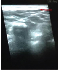 Bilateral Ultrasound-Guided Erector Spinae Plane Block for Management of Acute Postoperative Surgical Pain After Pediatric Cardiac Surgeries Through a Midline Sternotomy.