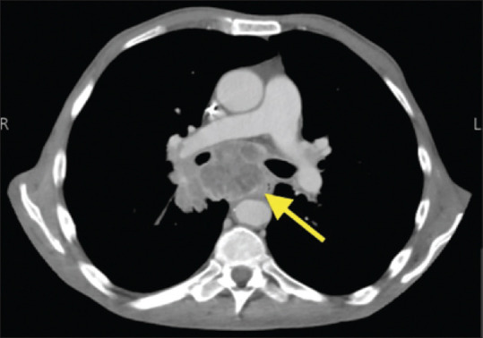 A Successful Awake Fiberoptic Bronchoscopy Intubation of a Cardiomorbid Patient: A Case Report.