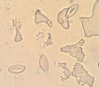 Refractory Enterobius vermicularis infection in an elderly woman: Mebendazole or albendazole?