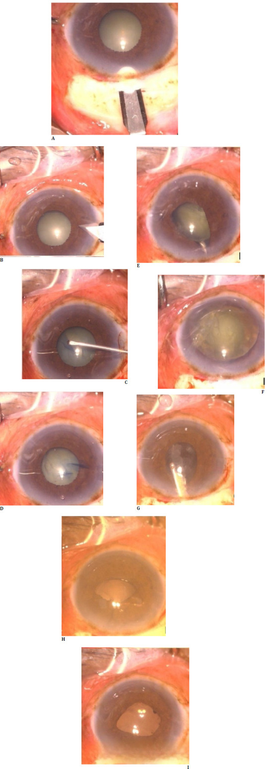 A case series on minor incision cataract surgery in small pupil without any aids.