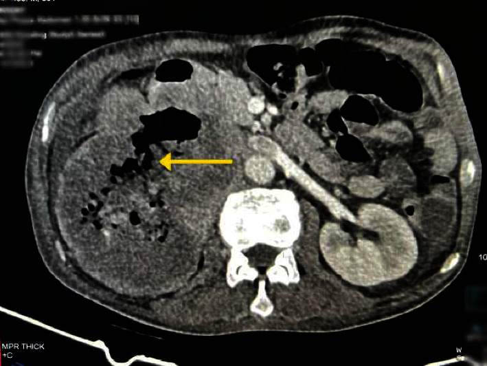 Renal Cell Carcinoma Masquerading as Acute Upper Gastrointestinal Bleeding.