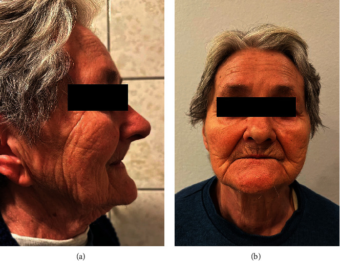 Traumatic Ulceration of the Vestibular Mucous Membrane After Insertion of Four Mini-Implants in the Atrophied Mandible: A Case Report.