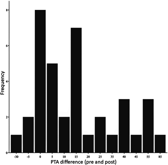 Results of a New Treatment Protocol for Sudden Sensorineural Hearing Loss Using Betamethasone for Intratympanic Therapy.