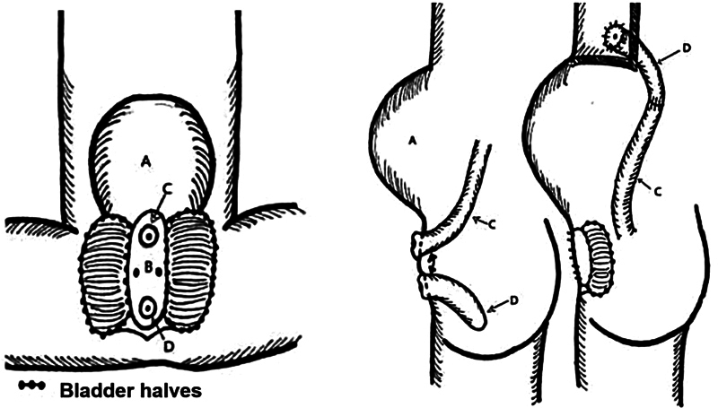 A Modification of the Newborn Operation for Cloacal Exstrophy: Leaving the Cecal Plate Untouched.