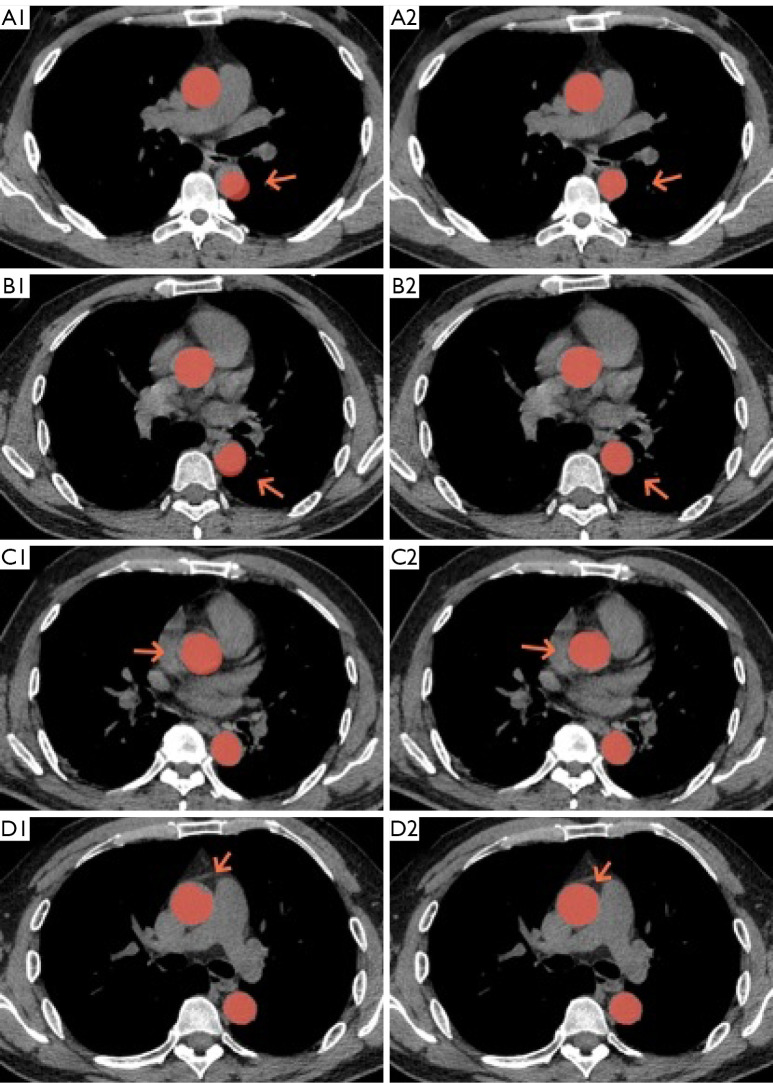 A deep learning algorithm for the detection of aortic dissection on non-contrast-enhanced computed tomography via the identification and segmentation of the true and false lumens of the aorta.