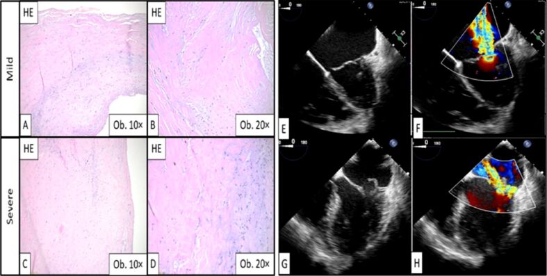 Significance of inflammation-related markers and histopathological features in mitral valve regurgitation.