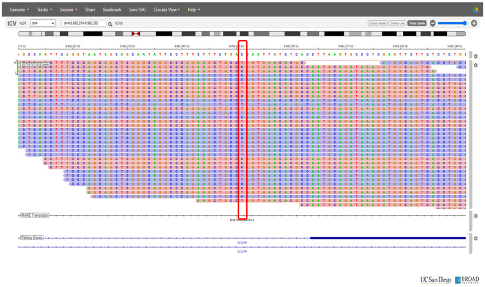 Renal hypouricemia type 2 with SLC2A9 compound heterozygous variants: a case report of recurrent acute kidney injury triggered by low-intensity exercise.