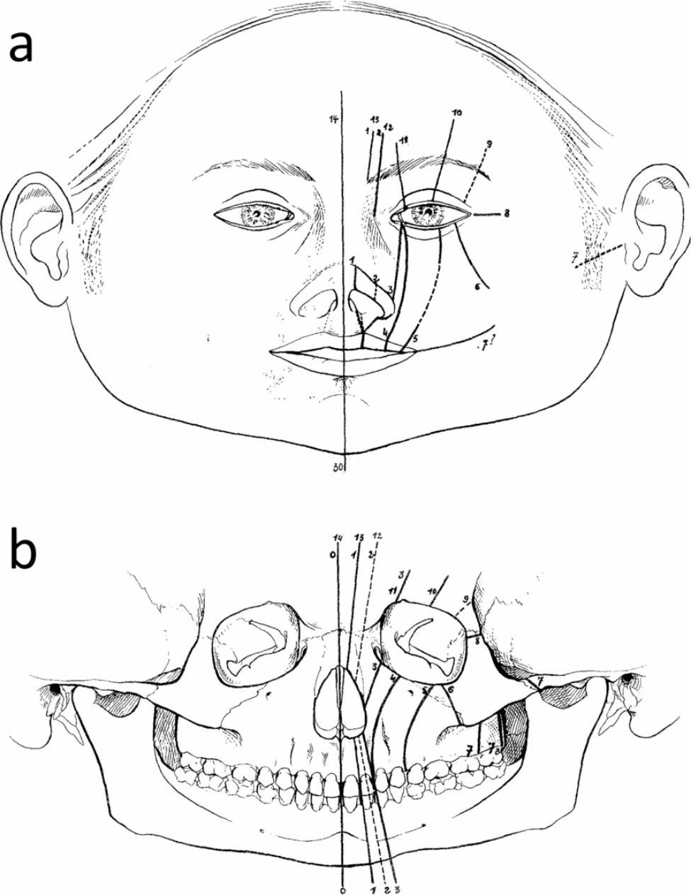 Detection of regions of homozygosity in an unusual case of frontonasal dysplasia.