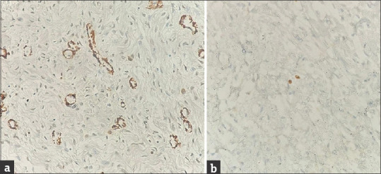Cervical Superficial Myofibroblastoma Presenting as a Polyp: A Rare Benign Entity.