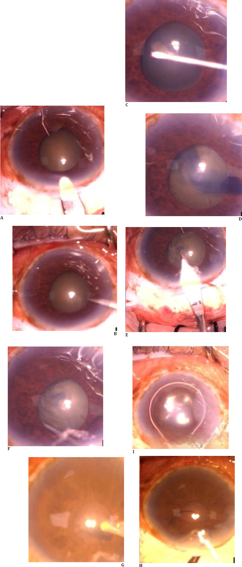 A case series on minor incision cataract surgery in small pupil without any aids.