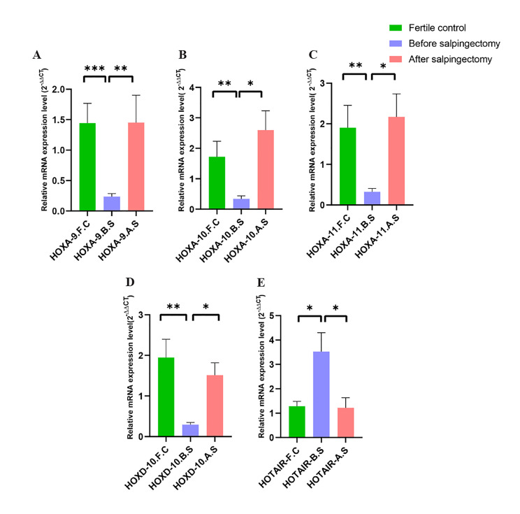 Laparoscopic Salpingectomy Regulates The Expression of Endometrial Homeobox Genes (<i>HOXA9, HOXA10, HOXA11, HOXD10</i>) and HOX Transcript Antisense Intergenic RNA in Women with Communicating Hydrosalpinx: A Prospective Study.